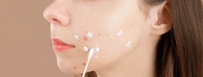 How To Clear Your Breakouts Naturally