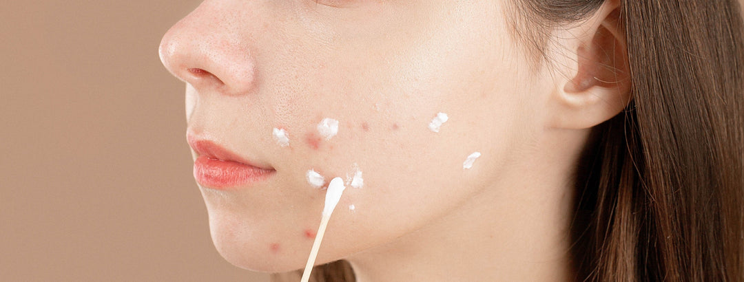 How to Clear Acne Naturally