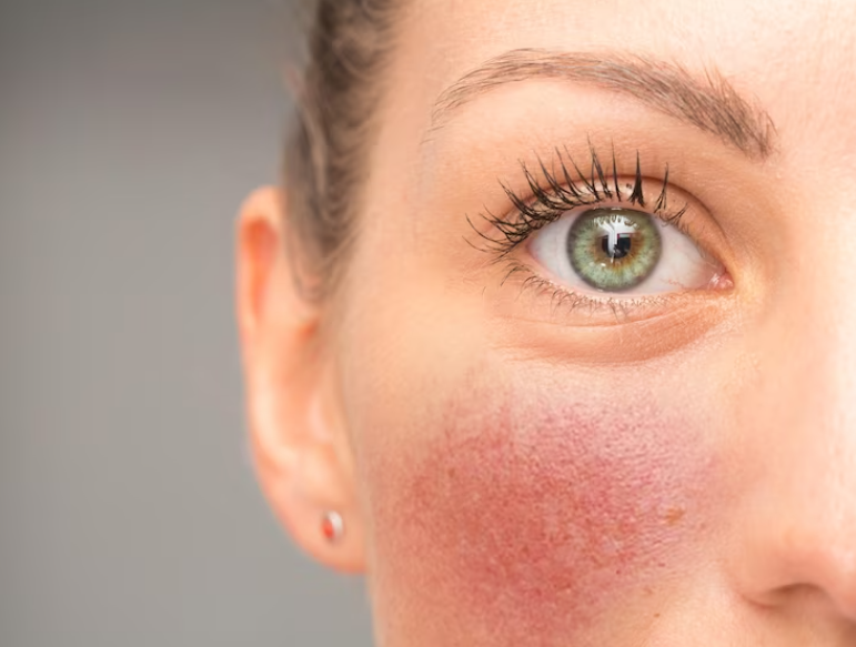 Rosacea Skin