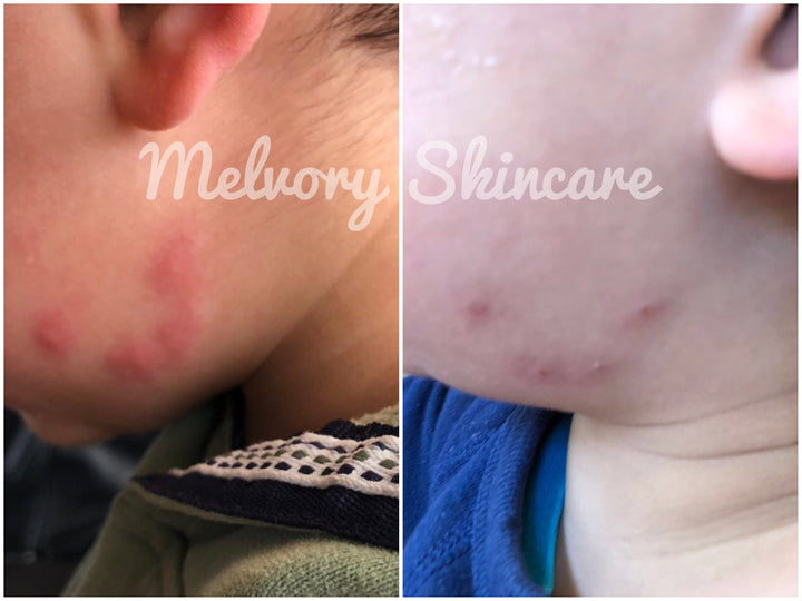 Natural Mozzie Relief Balm