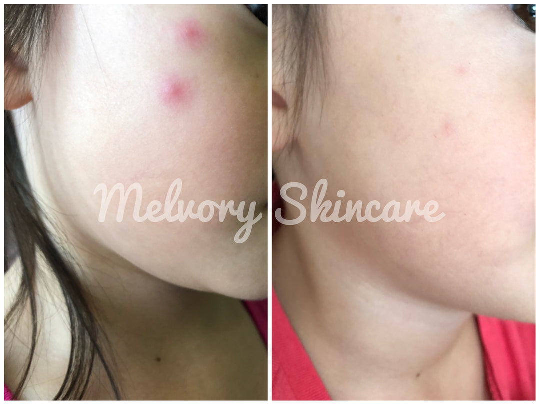 Natural Mozzie Relief Balm